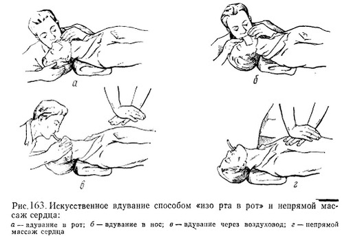 Искусственный массаж сердца. Непря ой массаж сердца офто. Освободить дыхательные пути искусственное дыхание массаж сердца. Массаж сердца и искусственное дыхание. Освободить дыхательные пути искусственное дыхание массаж сердца.